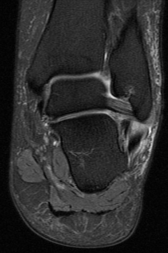 Figure 5 for case Peroneus brevis split tear